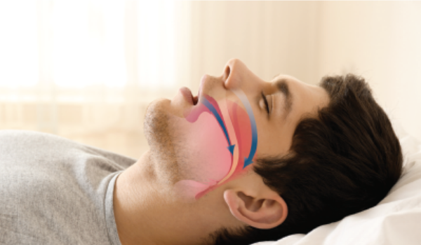 Syndrome d’apnée du sommeil et travail Miniature AISMT13 Homme souffrant du Syndrome d’apnée du sommeil