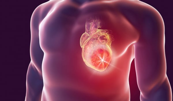 Illustration d'un homme torse nu dont on voit le cœur qui scintille pour illustrer un arrêt cardiaque
